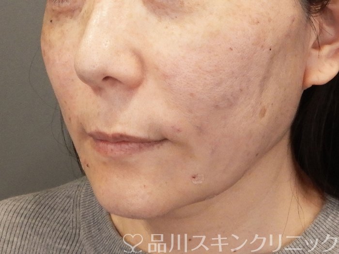 症例NO.70301のAFTER写真