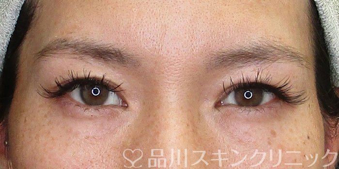 症例NO.74260のBEFORE写真