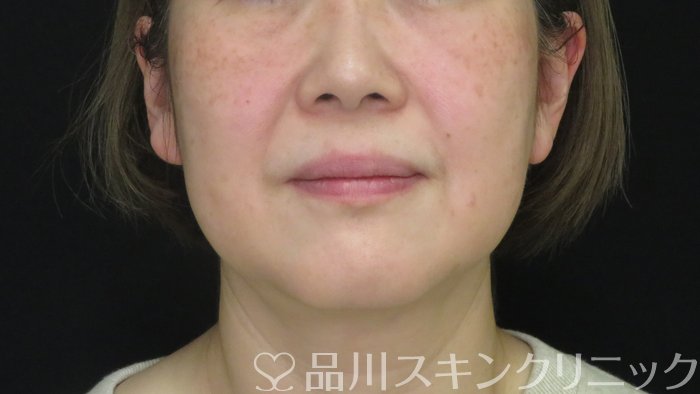 症例NO.73056のBEFORE写真