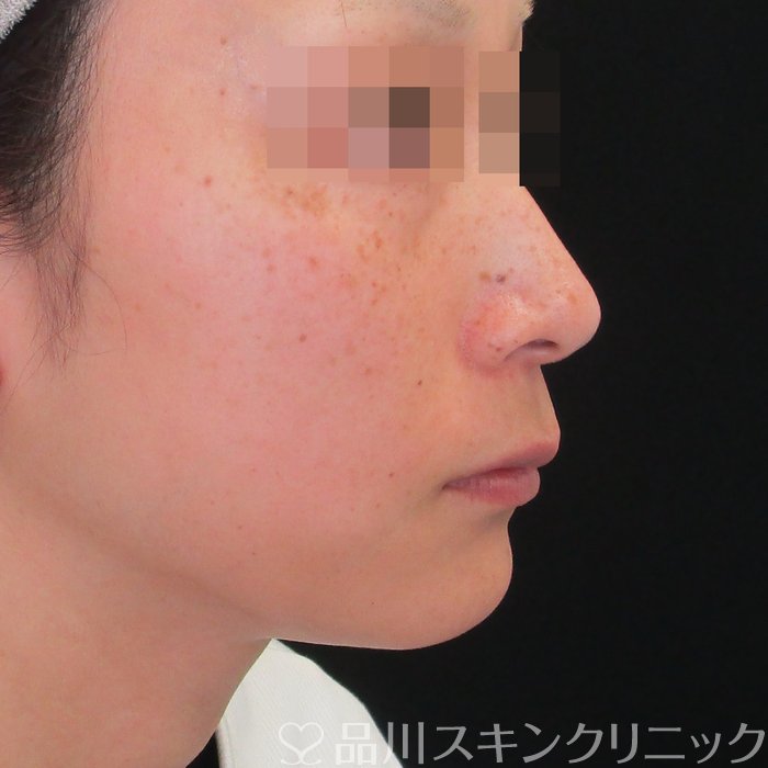 症例NO.75143のBEFORE写真