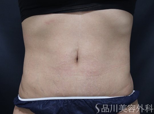 症例NO.75189のAFTER写真