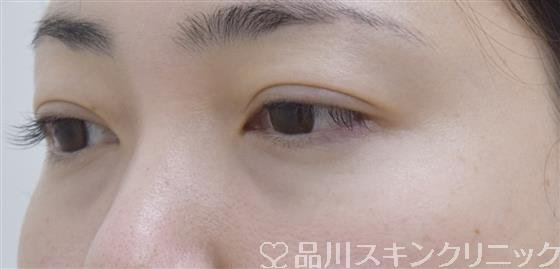 症例NO.52948のBEFORE写真