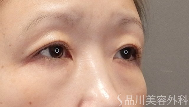 症例NO.75107のBEFORE写真