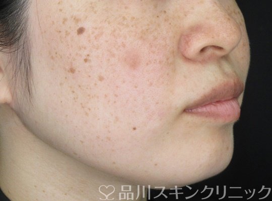 症例NO.70043のAFTER写真