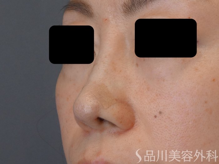 症例NO.72632のAFTER写真