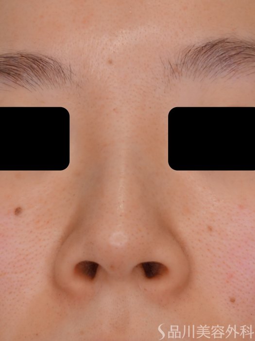 症例NO.73356のBEFORE写真