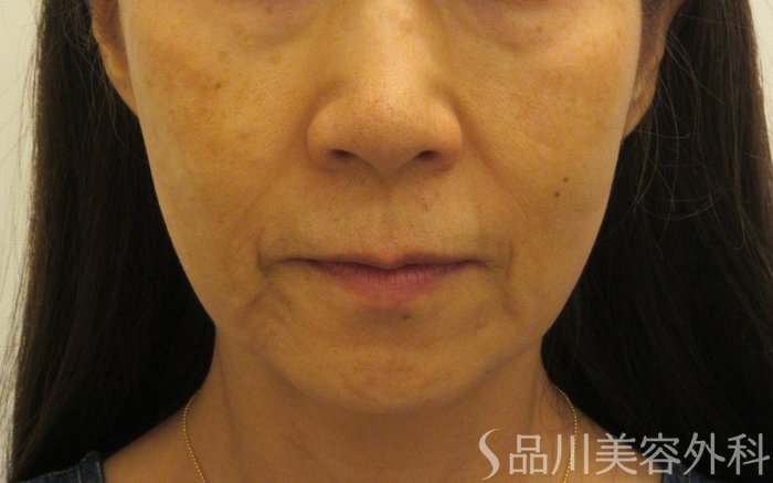 症例NO.71552のBEFORE写真