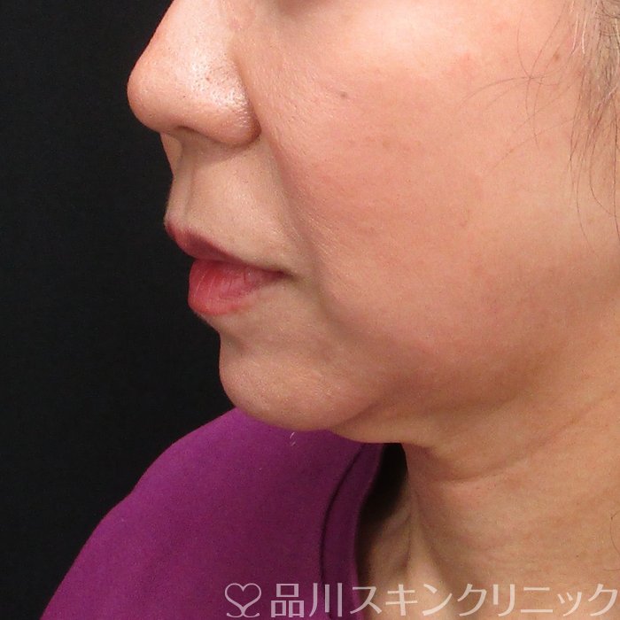 症例NO.72773のBEFORE写真