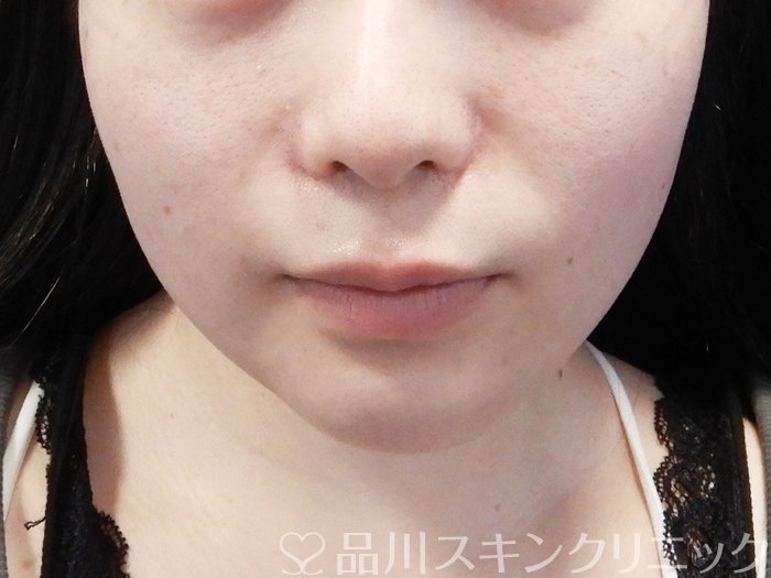 症例NO.72522のAFTER写真