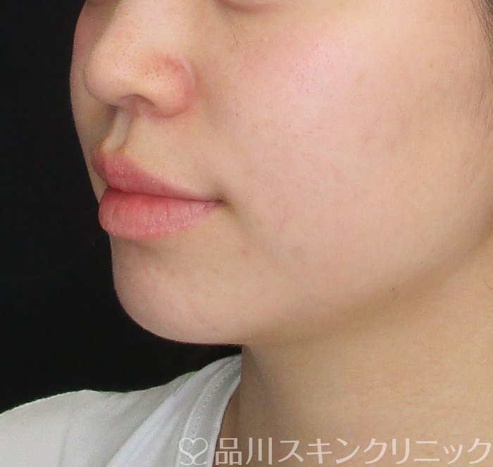 症例NO.74821のBEFORE写真