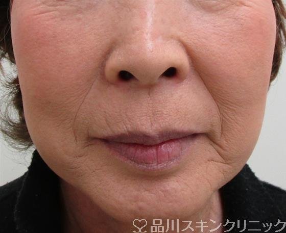 症例NO.33061のBEFORE写真