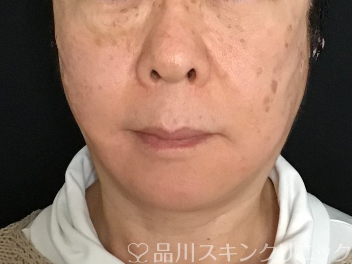 症例NO.65167のAFTER写真