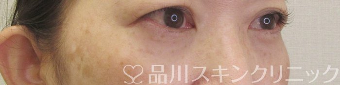 症例NO.71297のAFTER写真