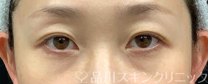 症例NO.71034のBEFORE写真