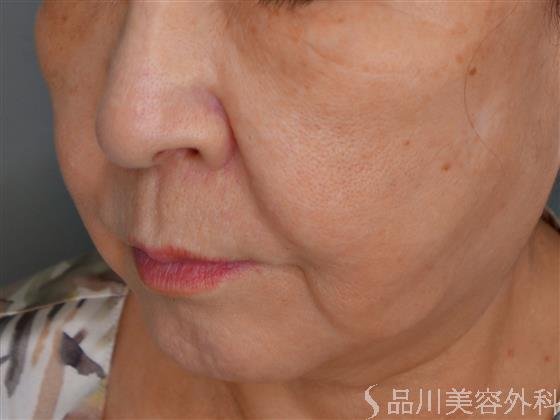 症例NO.52973のBEFORE写真