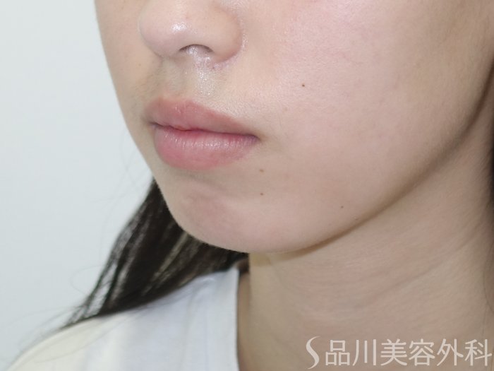 症例NO.69528のBEFORE写真