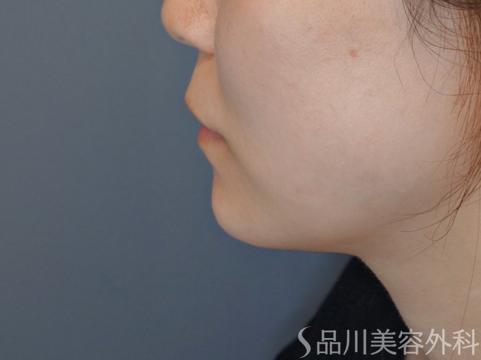 症例NO.68180のAFTER写真