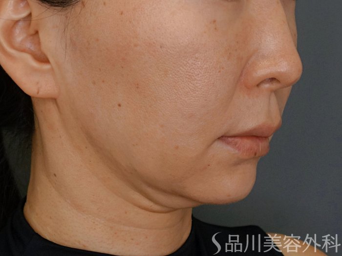 症例NO.74649のBEFORE写真