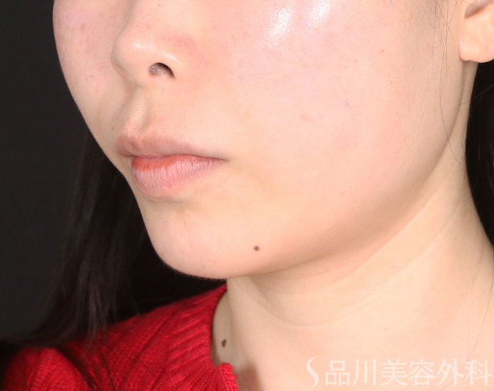 症例NO.73007のAFTER写真