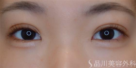 症例NO.50879のAFTER写真