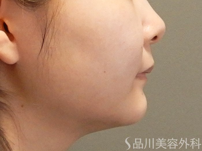 症例NO.67522のAFTER写真