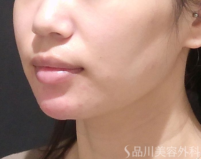 症例NO.67981のAFTER写真