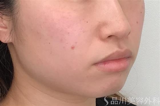 症例NO.55362のBEFORE写真