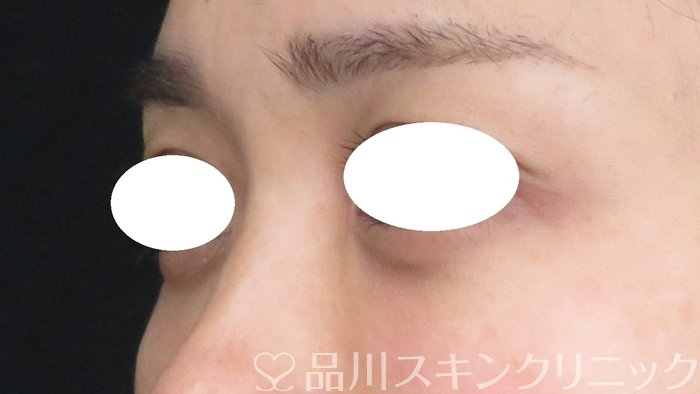 症例NO.62257のAFTER写真