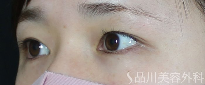 症例NO.69581のBEFORE写真