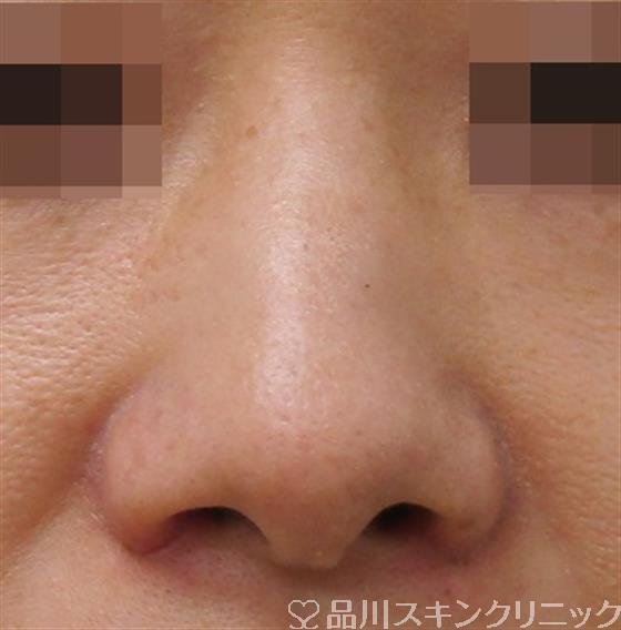 症例NO.38475のBEFORE写真