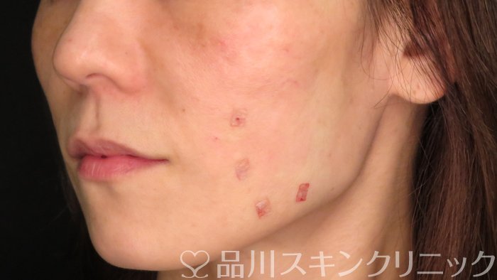 症例NO.70954のAFTER写真