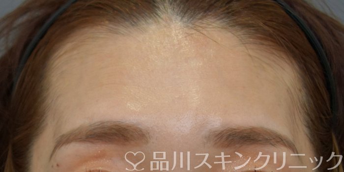 症例NO.74027のBEFORE写真