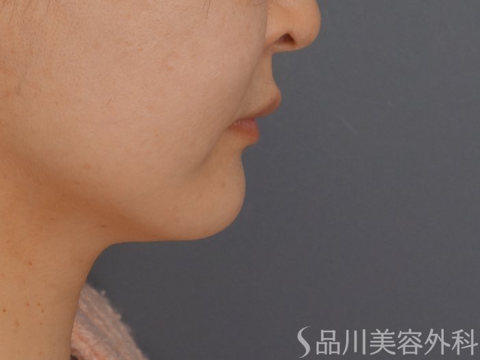 症例NO.69400のBEFORE写真