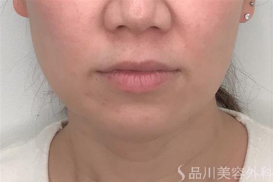 症例NO.55501のBEFORE写真