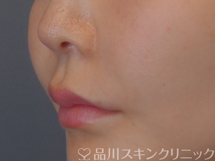 症例NO.72282のAFTER写真