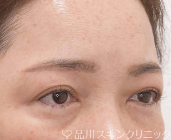 症例NO.73993のAFTER写真