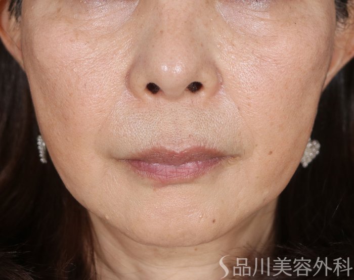 症例NO.73517のAFTER写真