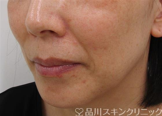 症例NO.37888のBEFORE写真