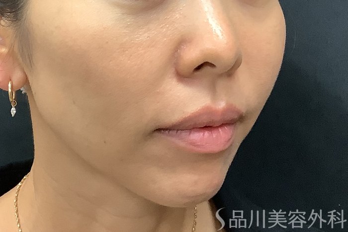 症例NO.71240のAFTER写真
