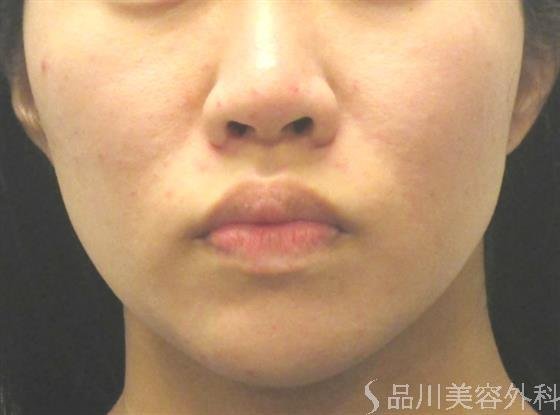 症例NO.40697のAFTER写真