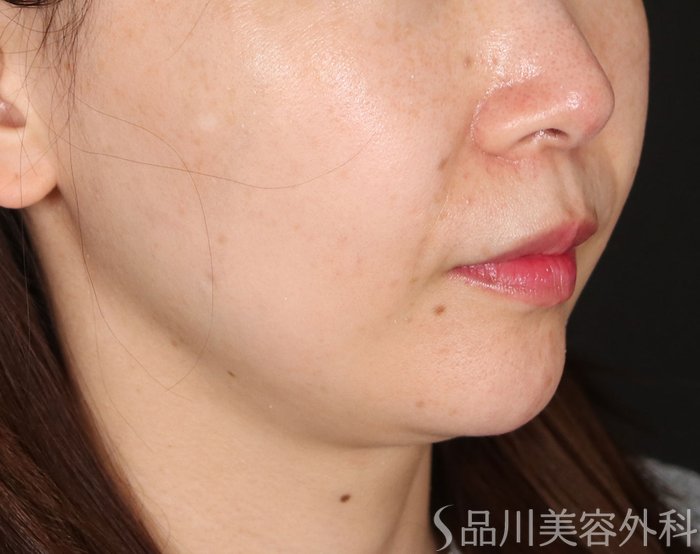 症例NO.73345のBEFORE写真