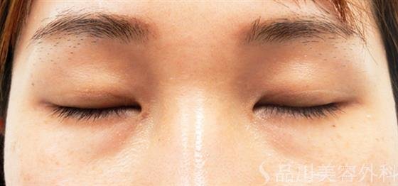 症例NO.53089のAFTER写真