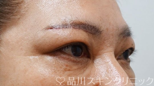 症例NO.69407のAFTER写真