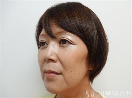 症例NO.26665のBEFORE写真