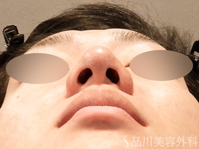 症例NO.70282のBEFORE写真