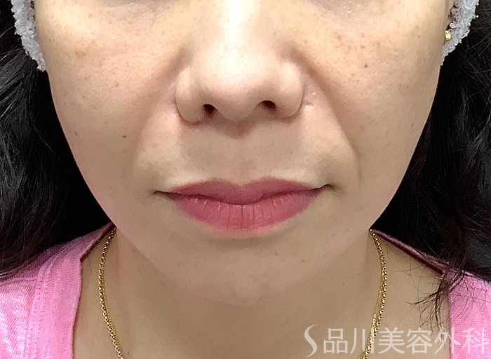 症例NO.75283のBEFORE写真