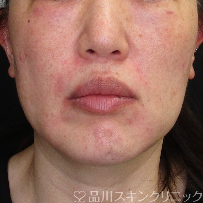 症例NO.73769のAFTER写真