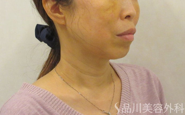 症例NO.72525のAFTER写真