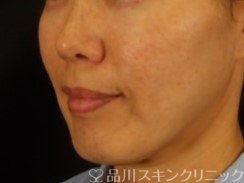 症例NO.72355のBEFORE写真