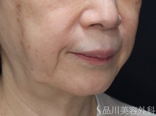 症例NO.74586のBEFORE写真